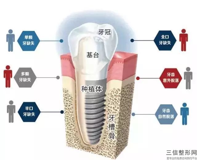 杭州玻璃離子補牙多少錢，通過這篇文章告訴你