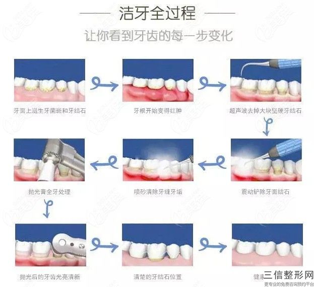 做矯正齙牙手術要5000~80000元左右的牙齒效果