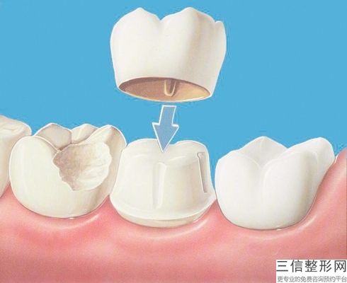 做全瓷牙一般多少錢可以呢？(圖)