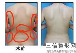 冷凍溶脂瘦大腿一般多少錢(冷凍溶脂瘦大腿大概價格參考表)