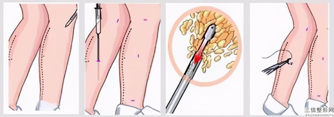 水動力吸脂瘦腰腹一般多少錢(水動力吸脂瘦腰腹大概價格參考表)