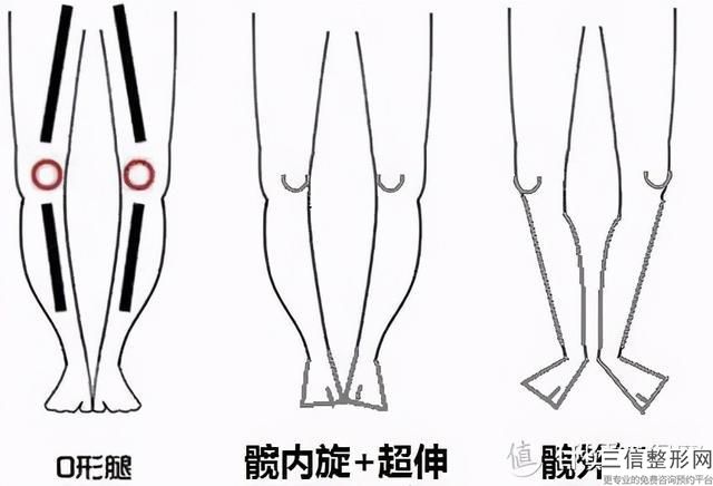 自體脂肪填充一般多少錢(自體脂肪填充大概價格參考表)