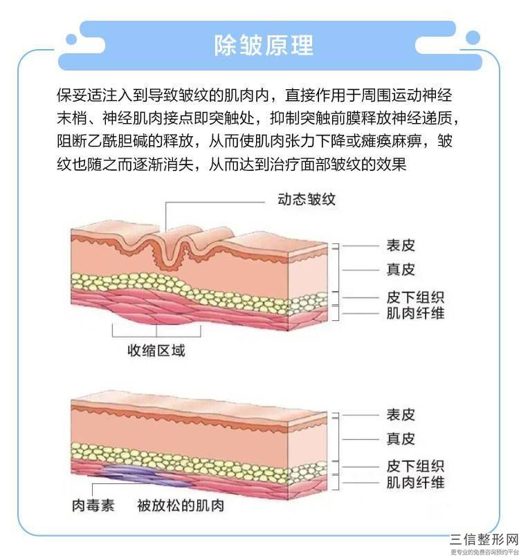 額頭拉皮祛皺手術費用有多貴