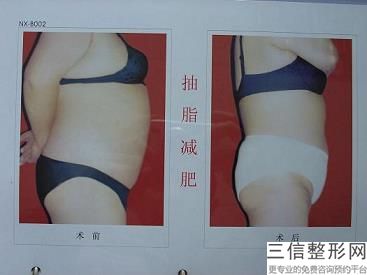 成都打消脂針瘦腿多少錢？溶脂針和瘦腿怎么樣