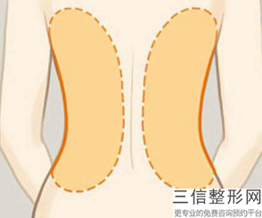 做共振吸脂瘦臀危險嗎？臀部吸脂減肥的方法