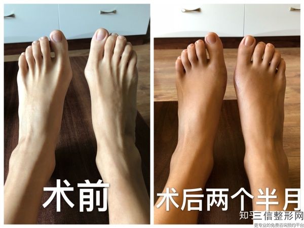 光纖維持溶脂瘦臉的實際效果和時間有什么不同