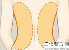 OPT激光痘印需要多久恢復？激光祛痘打印的時間