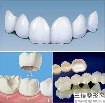 昆明的正畸拔牙多少錢？與校正方法有關？