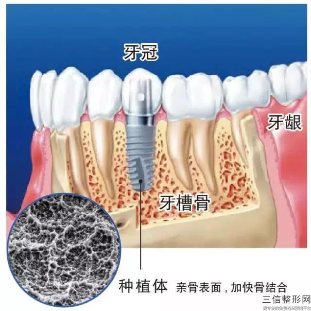 寧波的牙具多少錢？寧波無憂整形醫院口腔畸形矯正