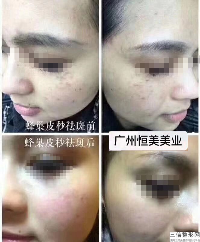 深圳美萊激光脫毛多少錢？價格是多少？怎么樣