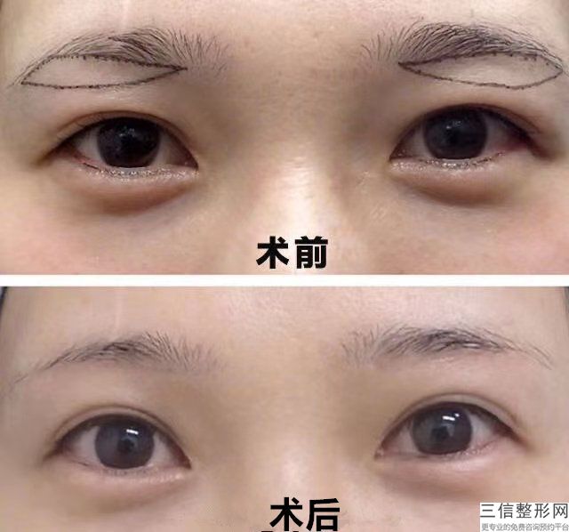 天津眼角手術的好價格在哪里？贅皮、擴大內眥可有效縮短眼間距