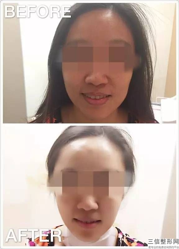 手術瘦咬肌多少錢,不打針不手術，如何瘦咬肌？