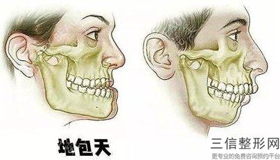 小切口面部提升術多少錢,小切口面部提升術多少錢