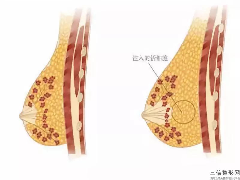 注射隆胸豐胸手術(shù)的效果會(huì)不會(huì)反彈