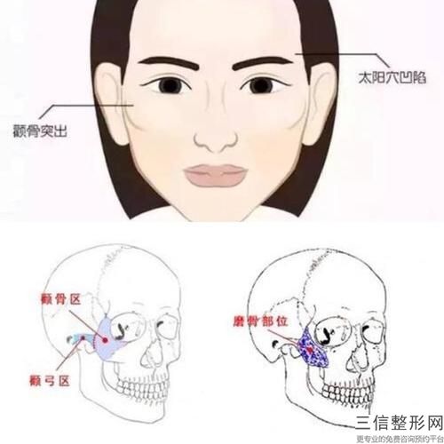 顴骨內推加磨骨大有多大的副作用