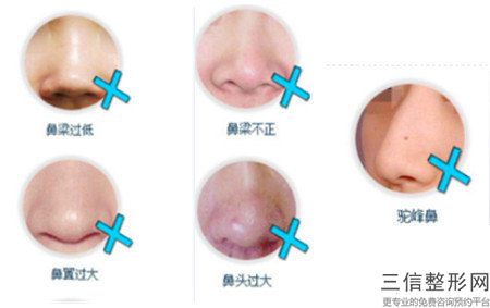 現(xiàn)在隆鼻大致要準備多少錢