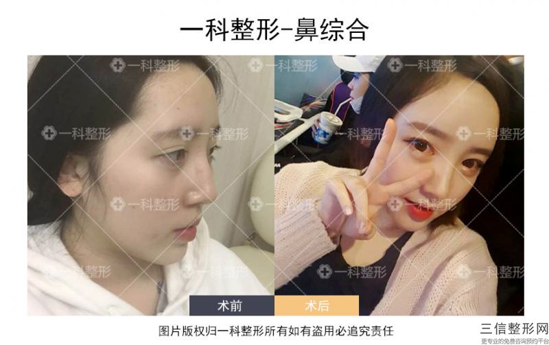 哈爾濱隆鼻手術哪家好！哈爾濱斯美諾醫療美容醫院不容錯過