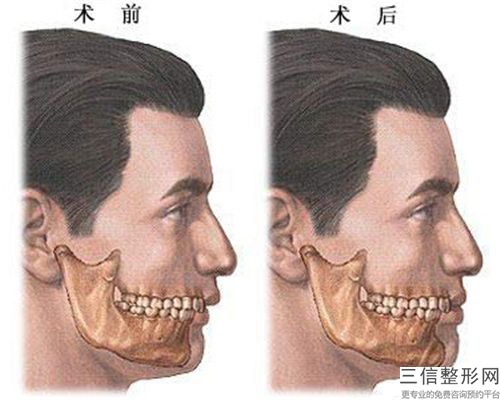 東營(yíng)市豐下巴假體排名榜前七公認(rèn)名單（東營(yíng)市豐下巴假體整形醫(yī)院）