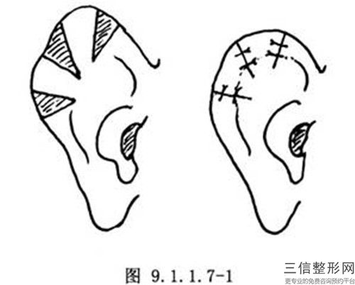 長(zhǎng)治市耳朵矯正整形手術(shù)熱門項(xiàng)目?jī)r(jià)格表劃算曝光-均價(jià)耳朵矯正整形手術(shù)18860元