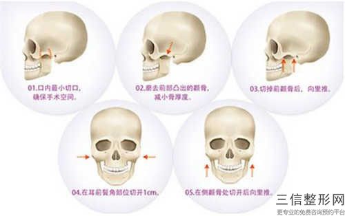 六盤水市下頜角磨削價(jià)格表新版一覽-六盤水市下頜角磨削整容全部費(fèi)用