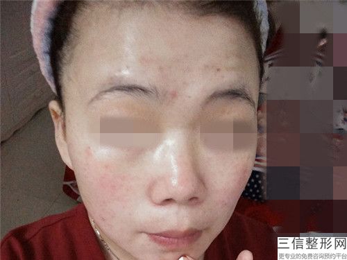 內蒙古自治區彩光治療黃褐斑醫生比較好的正規的有哪些-李宏亮醫生整形效果對比