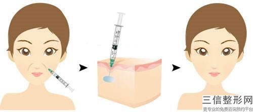 許昌玻尿酸去抬頭紋手術是如何確定費用的