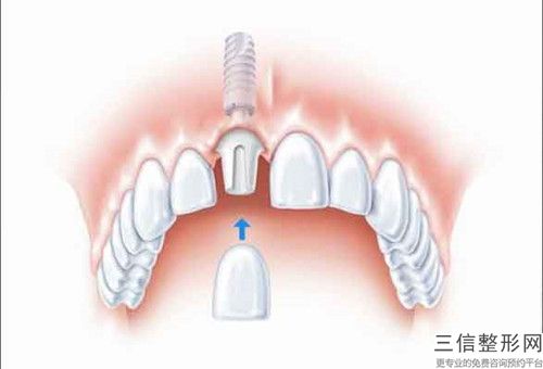 泉州牙齒牙根外露術(shù)究竟需要多少費(fèi)用