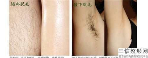 國內光子脫大腿毛醫院推薦：光子脫大腿毛醫院前50佳哪個技術比較好