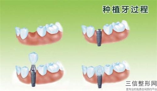 玉溪下門牙牙齦萎縮大概價格是多少