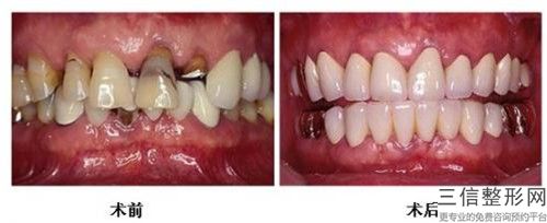 南京牙齦退縮價(jià)格具體要多少,南京牙齦退縮整形大概費(fèi)用是多少