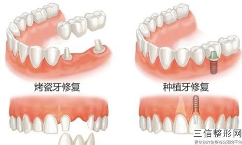 三門峽半口牙缺失價格大概需要花多少錢