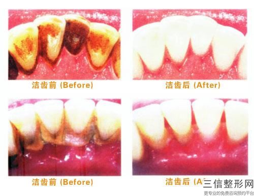 龍巖拔牙術手術的費用是多少錢呢