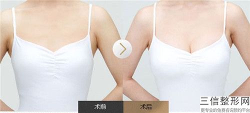 上海手術去副乳術能不能持久維持