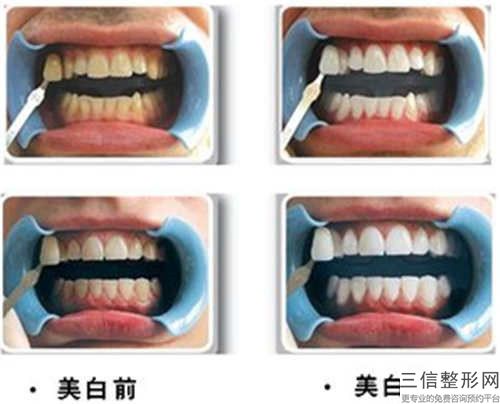 揚州全冠修復牙齒手術后幾天開始有效果