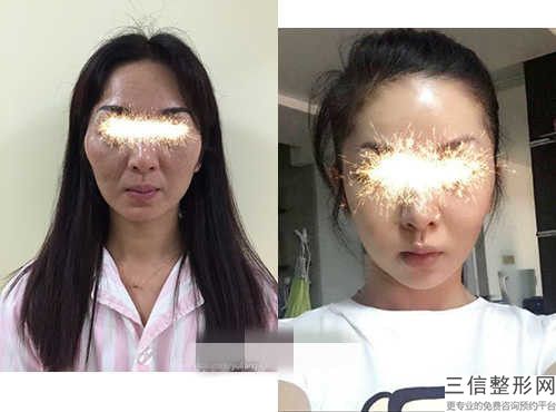 葉 華下頜智齒正位拔出手術(shù)后效果自然么