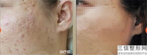 昆明激光去黑毛痣整形安全性如何