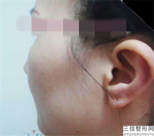 鄂州做磨骨手術失敗修復整形后需要女性注意哪些