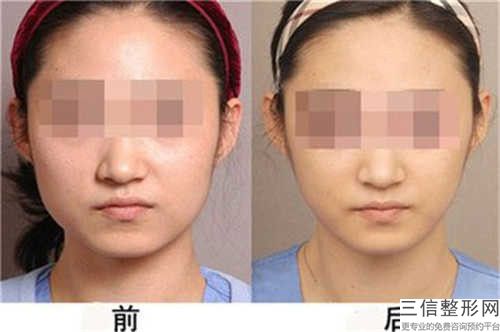 滄州奧拉克美容整形醫院價格價位表全新被曝光-豐下顎案例