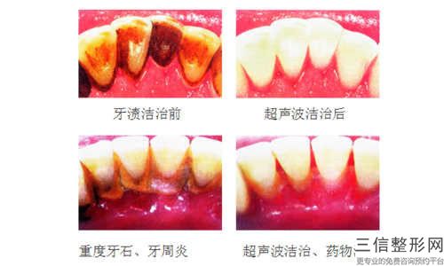 成都艾美薇醫(yī)療美容墊高后牙矯正深覆合后護理應該怎么做