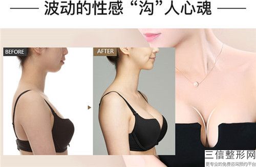 謝肇菊巨乳懸吊術手術具體有哪些后遺癥呢