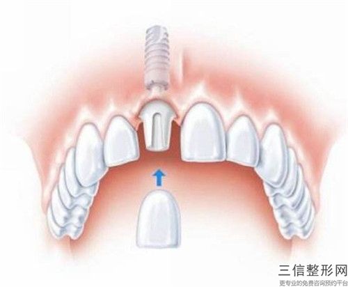 佛山澳瑪醫(yī)療美容醫(yī)院下半口牙種植出現(xiàn)的不良反應(yīng)有哪些