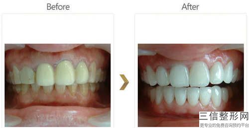 梧州種植牙護理手術到哪家整形效果好