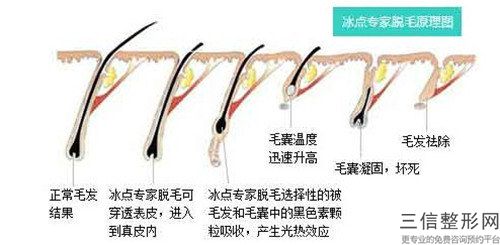 江北口腔門診部發際線高植發有不有副作用呢