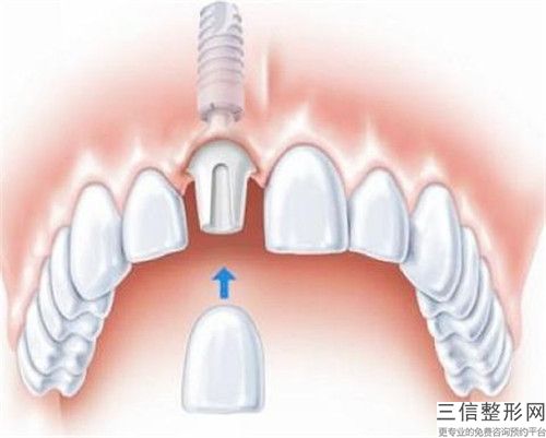 無錫康貝佳口腔醫院上牙外凸矯正失敗修復后遺癥