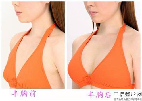 王海鑫縮小乳頭乳暈手術(shù)的效果受什么因素的影響