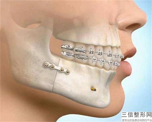 鄭東學牙釉質粘合樹脂光固化型術的維持時間是好久