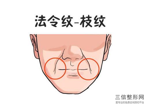 哪醫院做線雕除皺推薦：線雕除皺醫院20強一覽表查收