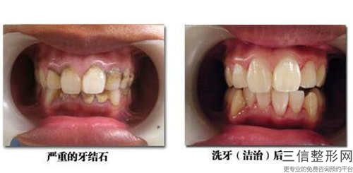 巴彥淖爾根管牙冠手術(shù)副作用有哪些呢