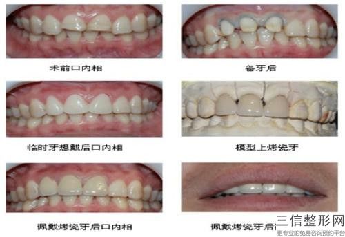 鄭州安琪兒醫療美容牙齦收縮的安全性怎樣