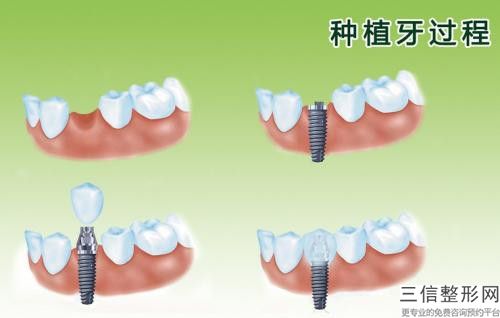 肖征剛舌側全隱形牙齒矯正整形的并發癥及效果